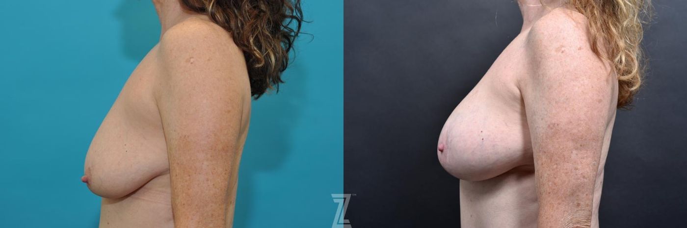 Austin Side breast view 7 year post op mommy makeover - The Piazza Center, Austin Tx - The Piazza Center