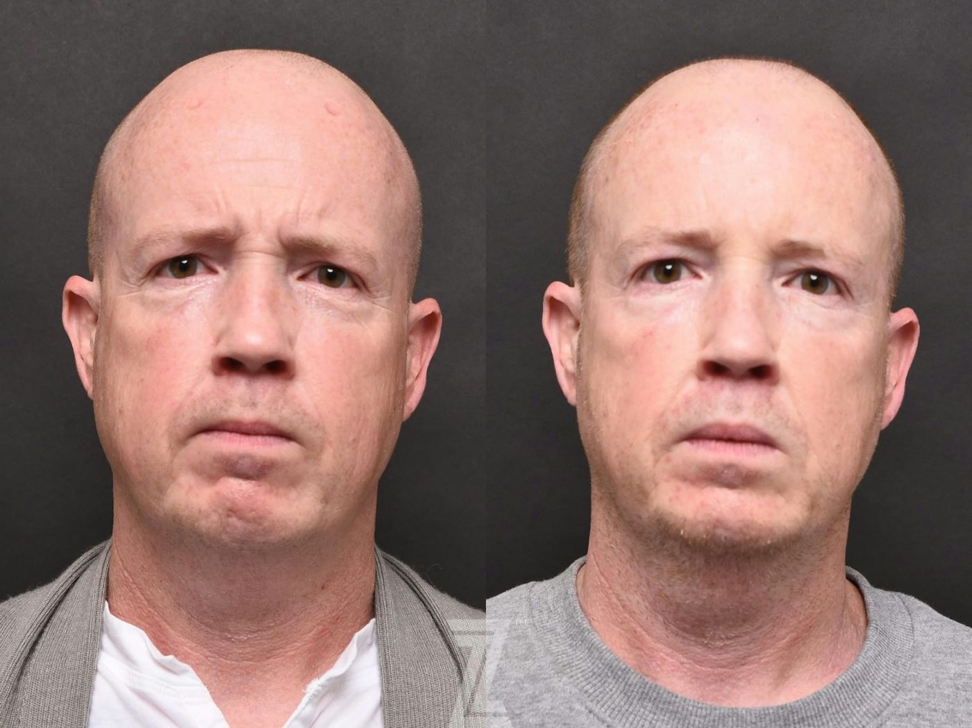 Austin Wrinkle Relaxers Before & After Gallery - Patient 132906313 - Image 2 - The Piazza Center