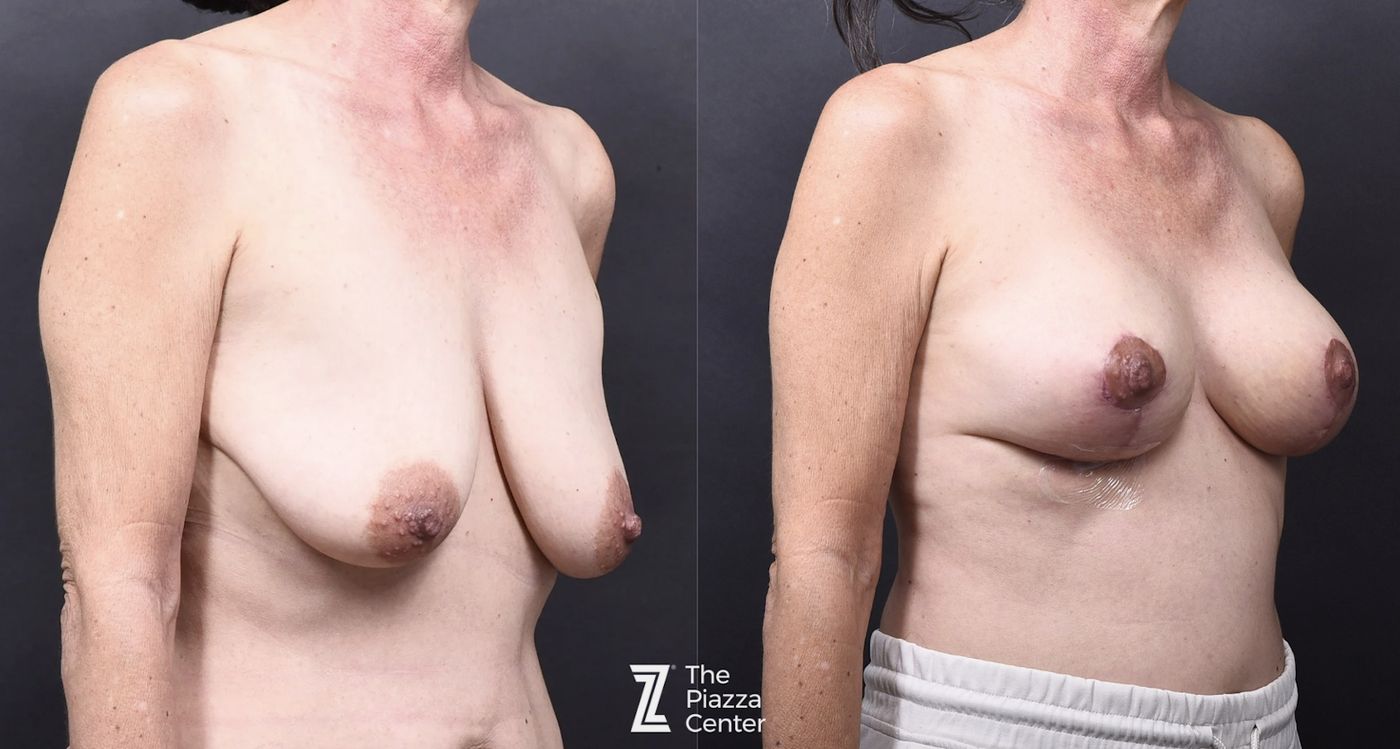Austin Breast Augmentation With a Breast Lift - The Piazza Center