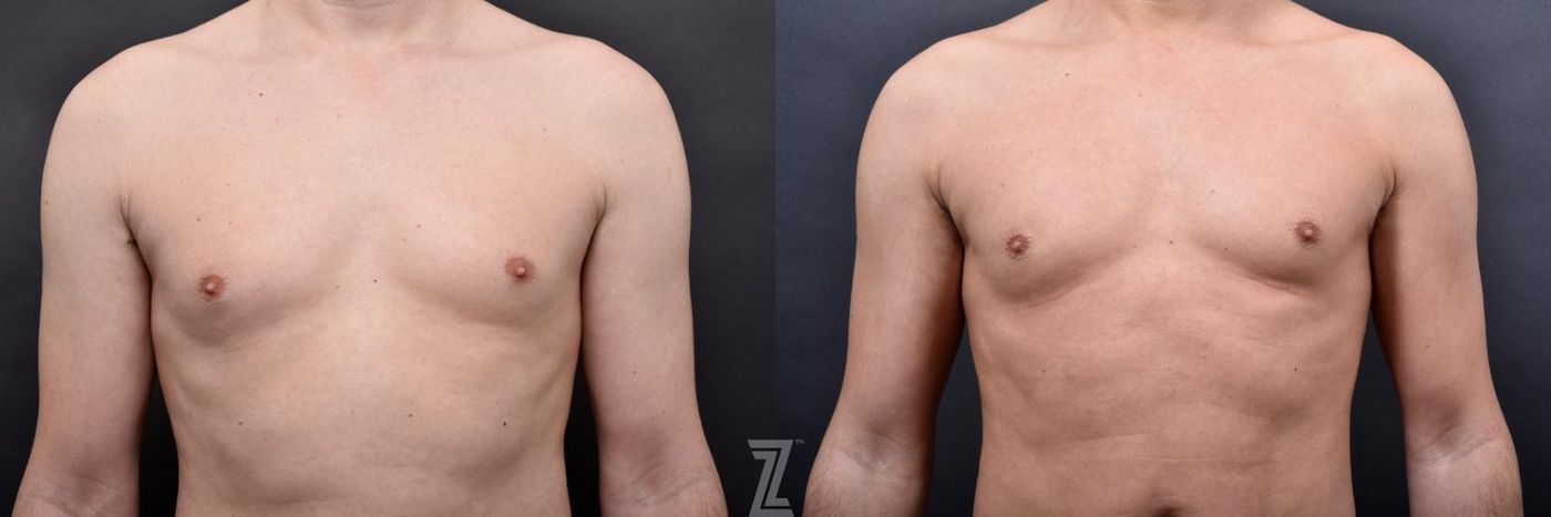 Austin Male Body Contouring Before & After Gallery - Patient 273342 - Image 4 - The Piazza Center