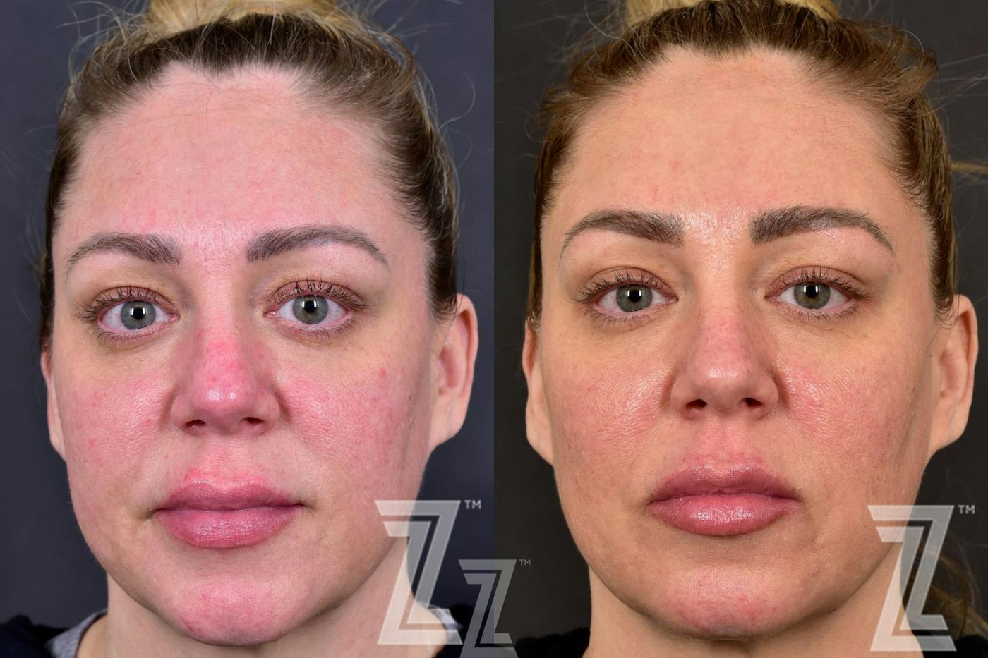 Austin BBL Before & After Gallery - Patient 132963256 - Image 1 - The Piazza Center