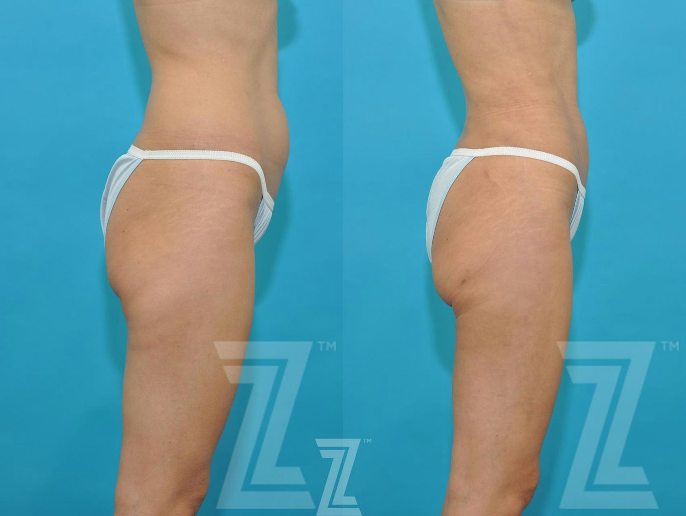 Austin Liposuction Before & After Gallery - Patient 132893822 - Image 4 - The Piazza Center