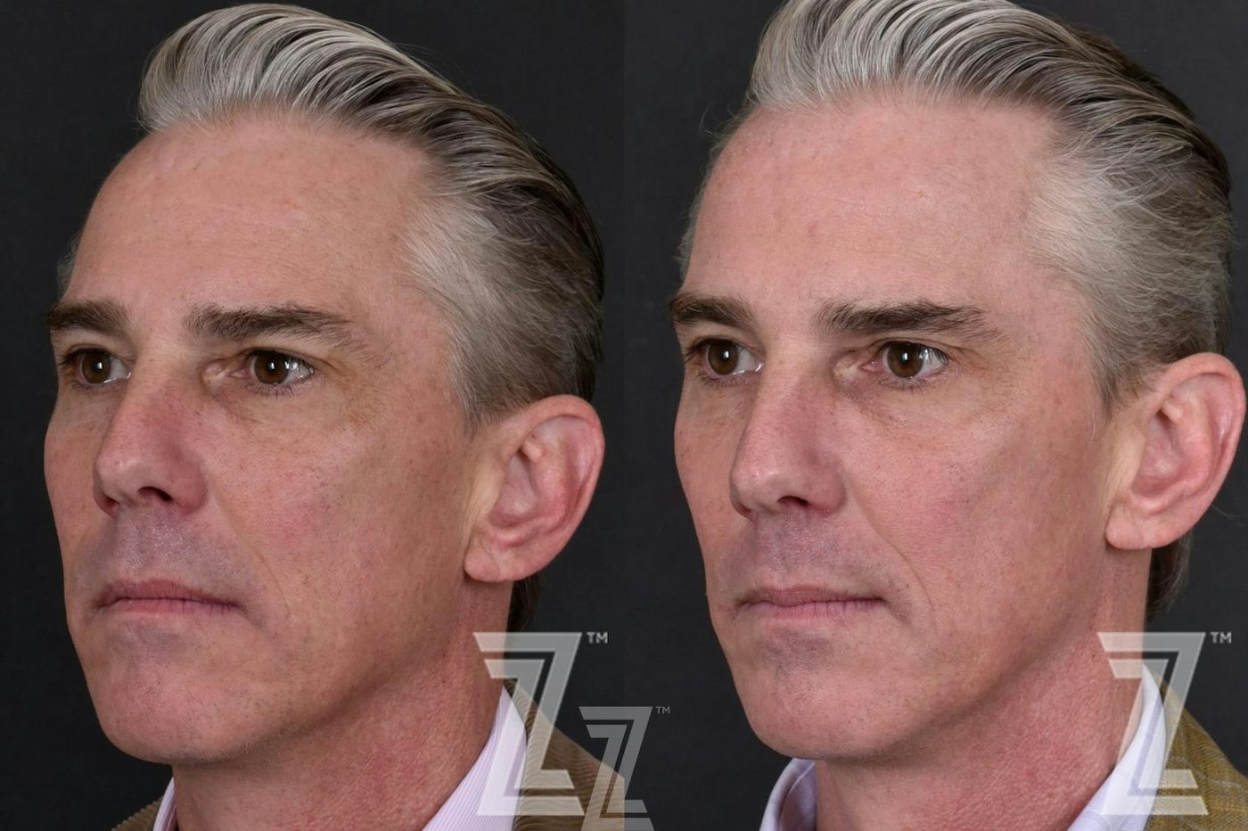 Austin Male Skin Treatments Before & After Gallery - Patient 336028 - Image 2 - The Piazza Center
