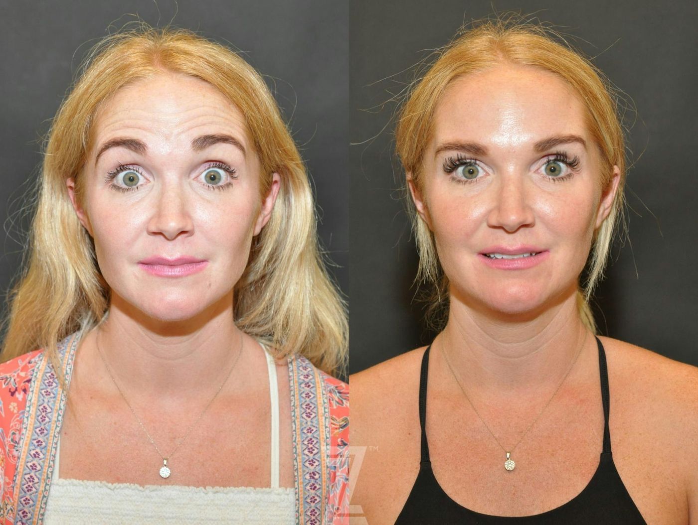 Austin Wrinkle Relaxers Before & After Gallery - Patient 132906317 - Image 2 - The Piazza Center