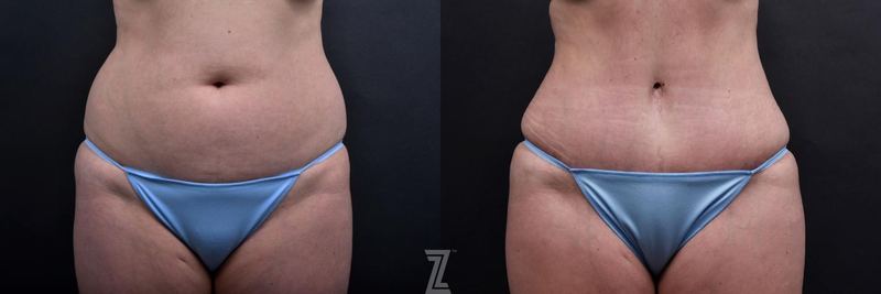 Austin Tummy Tuck Before & After Gallery - Patient 132886885 - Image 1 - The Piazza Center