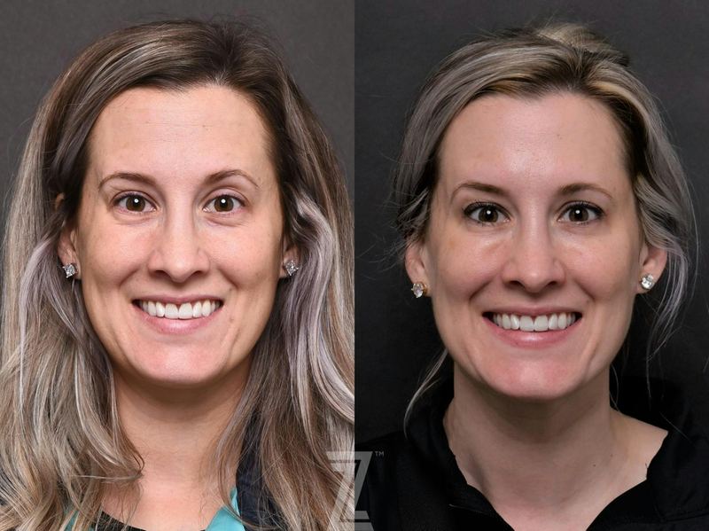 Austin Injectable Fillers Before & After Gallery - Patient 132963122 - Image 1 - The Piazza Center