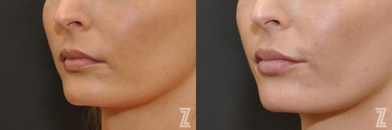 Austin Injectable Fillers Before & After Gallery - Patient 132963103 - Image 1 - The Piazza Center