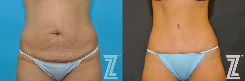 Austin Tummy Tuck Before & After Gallery - Patient 132886888 - Image 1 - The Piazza Center