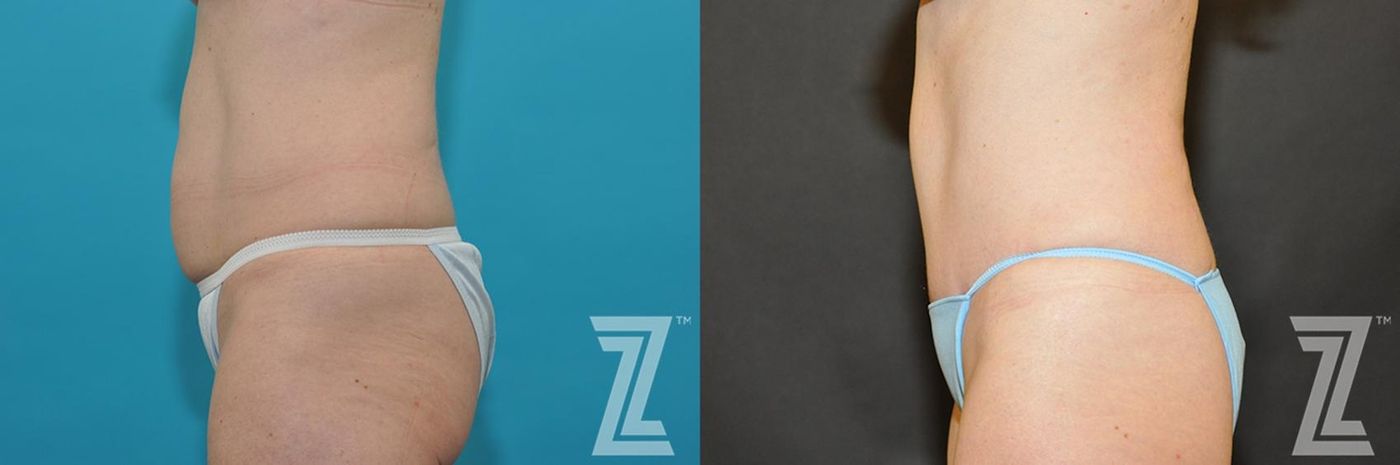 Austin Tummy Tuck Before & After Gallery - Patient 132886891 - Image 2 - The Piazza Center