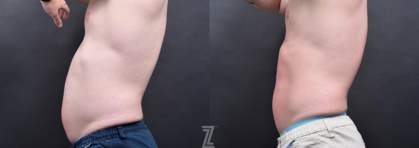 Austin Emsulpt Neo® Before & After Gallery - Patient 132905398 - Image 2 - The Piazza Center