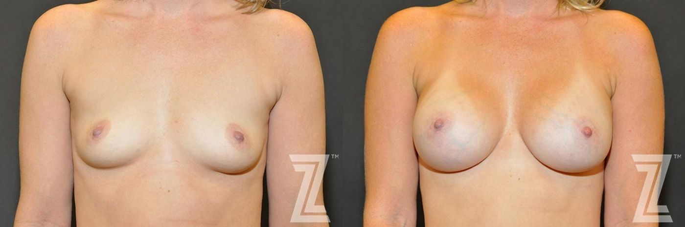 Austin Frontal view before & after images of 35-year-old mother of two 8 month post op breast augmentation - Dr. Rocco Piazza - The Piazza Center