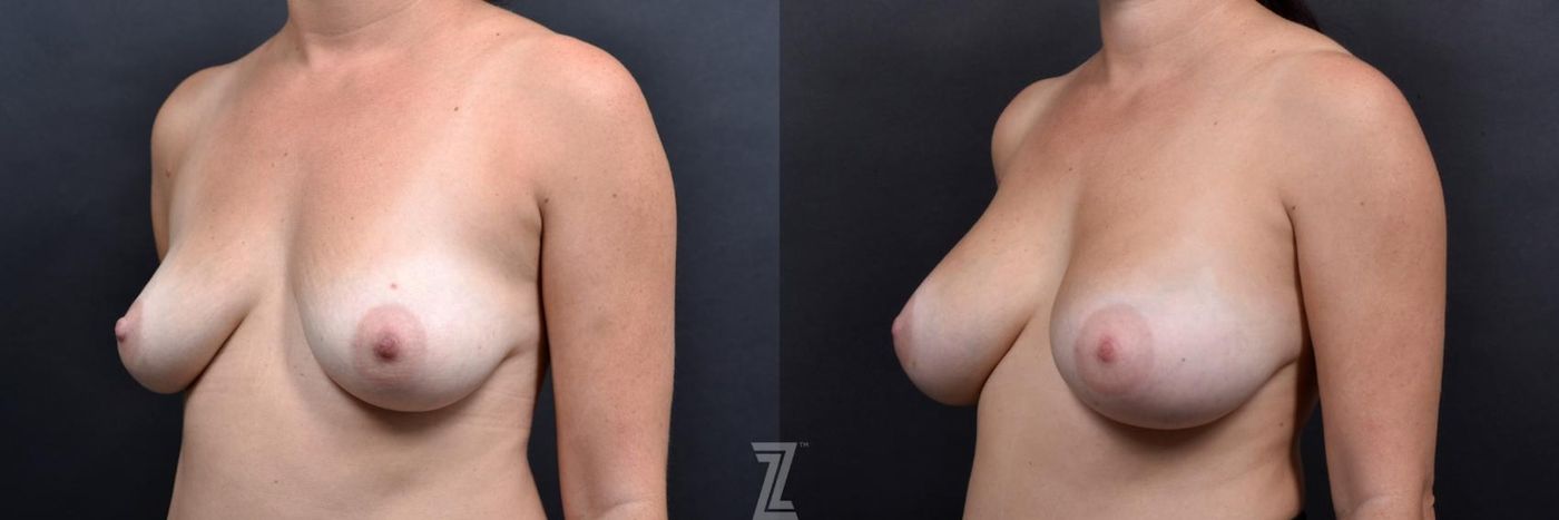 Austin Oblique view of 36 year old woman with Silicone Implants with Cohesive Silicone Gel at the Piazza Center - The Piazza Center