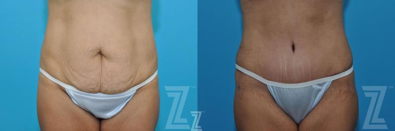 Austin Tummy Tuck Before & After Gallery - Patient 132886898 - Image 1 - The Piazza Center