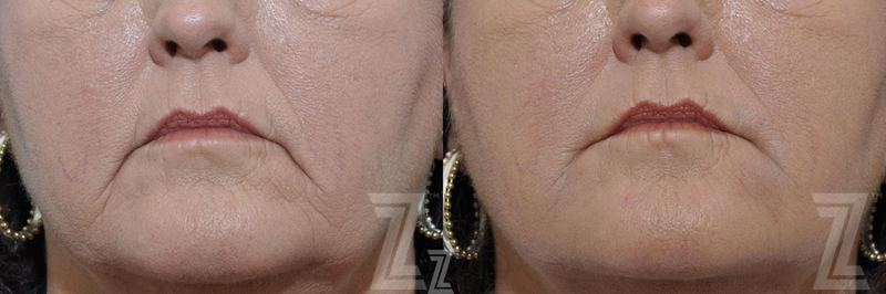 Austin Injectable Fillers Before & After Gallery - Patient 132963113 - Image 1 - The Piazza Center