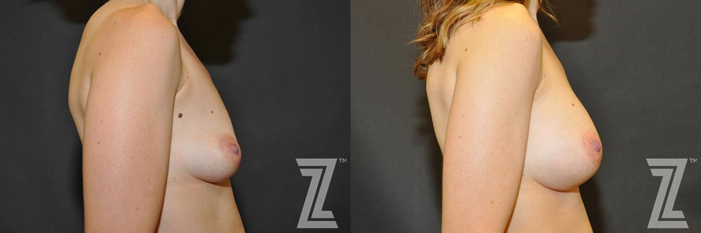 Austin Lateral view before & after of 34 year old woman with Silicone Implants with Cohesive Silicone Gel - The Piazza Center - The Piazza Center