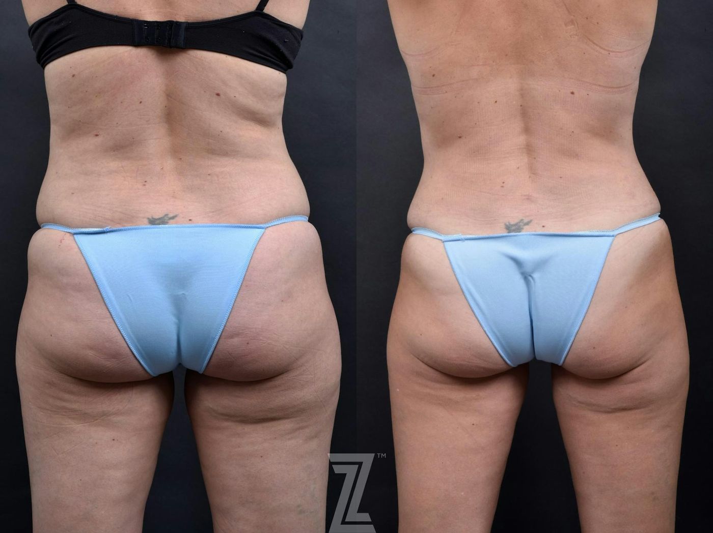 Austin Tummy Tuck Before & After Gallery - Patient 132886865 - Image 6 - The Piazza Center