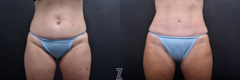 Austin Tummy Tuck Before & After Gallery - Patient 132886865 - Image 1 - The Piazza Center