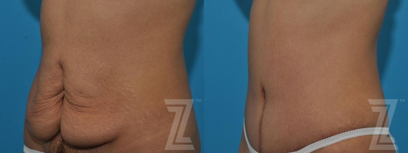 Austin Tummy Tuck Before & After Gallery - Patient 132886797 - Image 2 - The Piazza Center