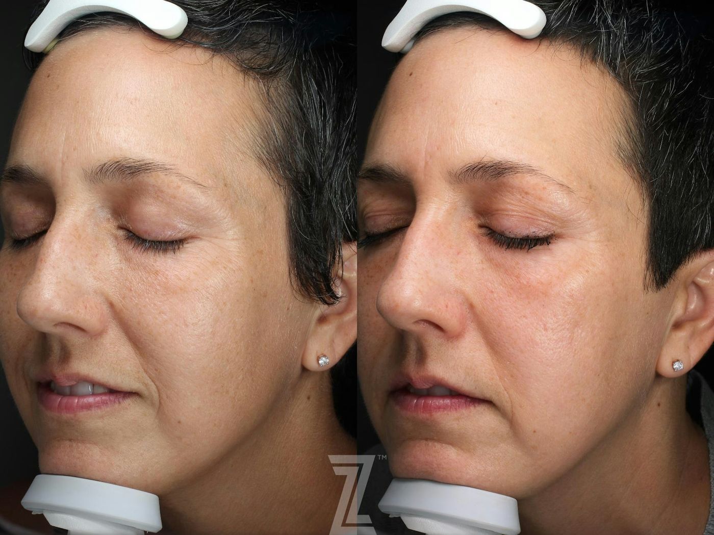 Austin HALO Before & After Gallery - Patient 386324 - Image 3 - The Piazza Center