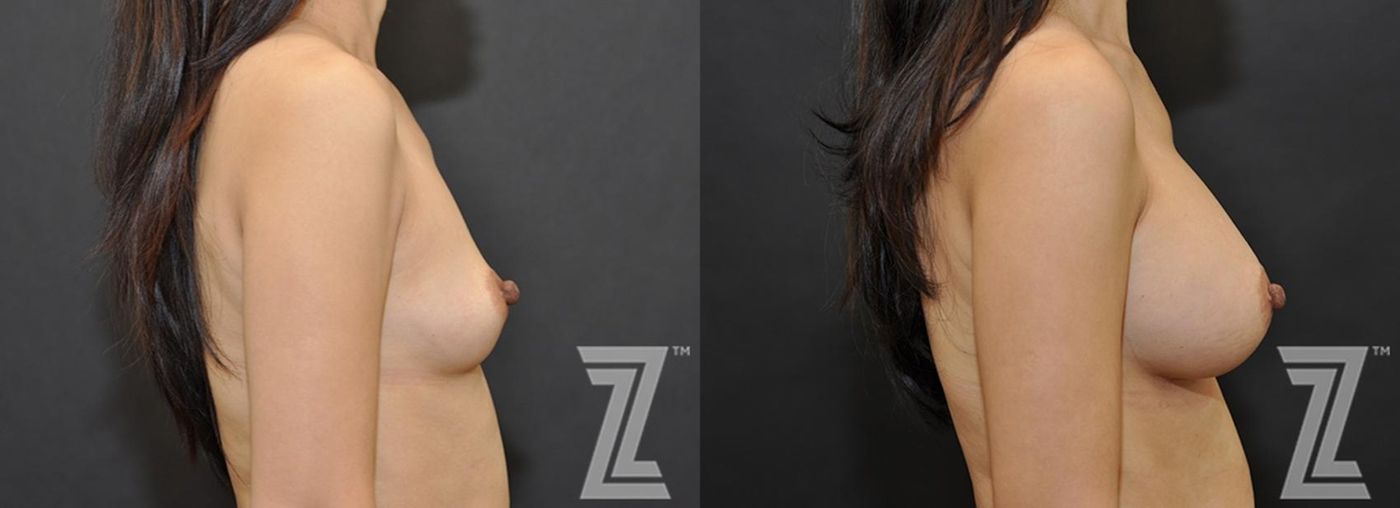 Austin Lateral view of Before & After image of woman with Silicone Implants with Highly Cohesive Gel (Gummy Bear Implants) - The Piazza Center
