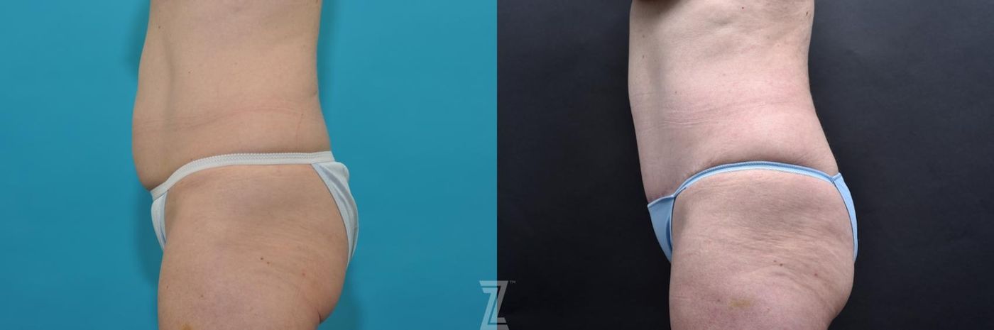 Austin Lateral abdominal view 7 year post op mommy makeover - The Piazza Center, Austin Tx - The Piazza Center