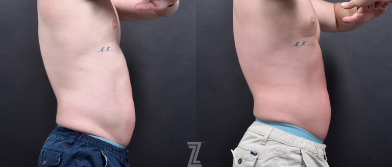 Austin Emsulpt Neo® Before & After Gallery - Patient 132905398 - Image 1 - The Piazza Center
