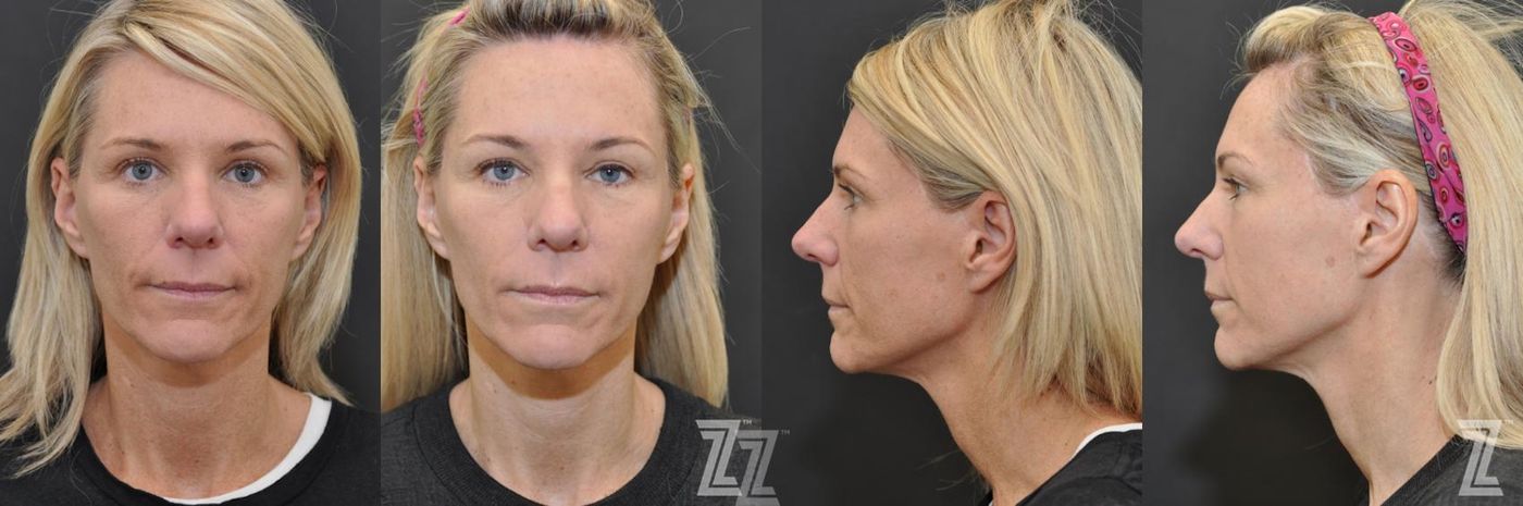 Austin Chemical Peel Before & After Gallery - Patient 132963245 - Image 1 - The Piazza Center