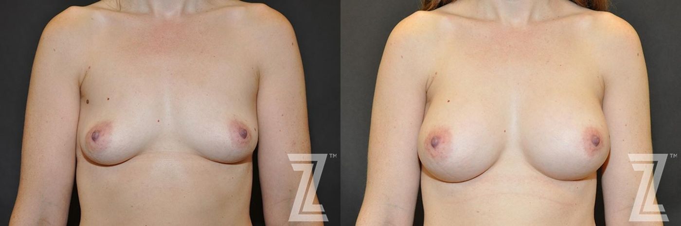 Austin Bilateral view before & after of 34 year old woman with Silicone Implants with Cohesive Silicone Gel - The Piazza Center - The Piazza Center