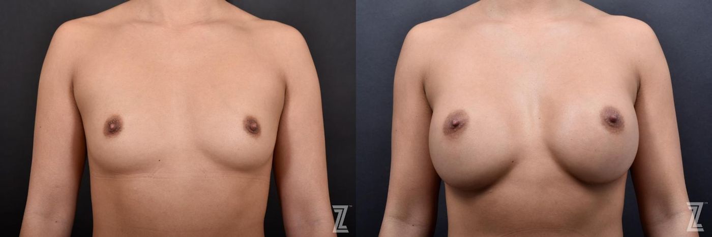 Austin Before & After Breast Augmentation of 25-Year-Old Female Patient at The Piazza Center in Austin - Dr. Piazza - The Piazza Center