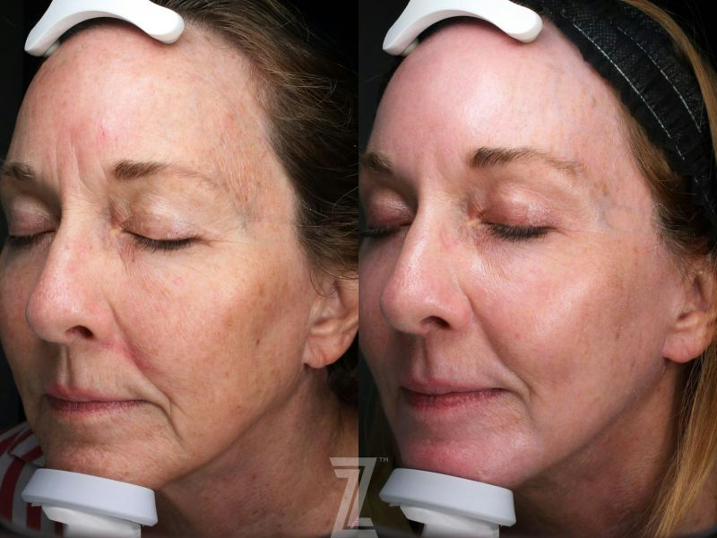 Austin Injectable Fillers Before & After Gallery - Patient 153838 - Image 1 - The Piazza Center