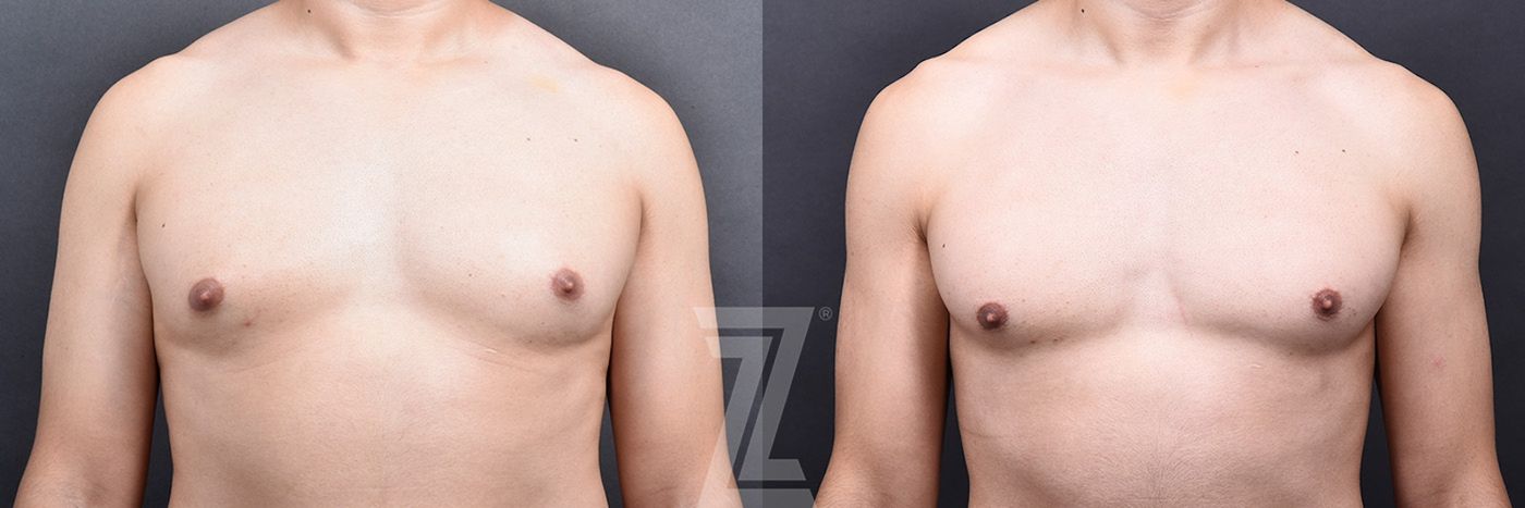 Austin Gynecomastia/Male Breast Reduction Before & After Gallery - Patient 105962 - Image 1 - The Piazza Center