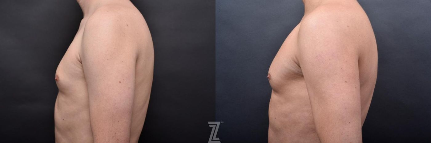 Austin Male Body Contouring Before & After Gallery - Patient 273342 - Image 6 - The Piazza Center