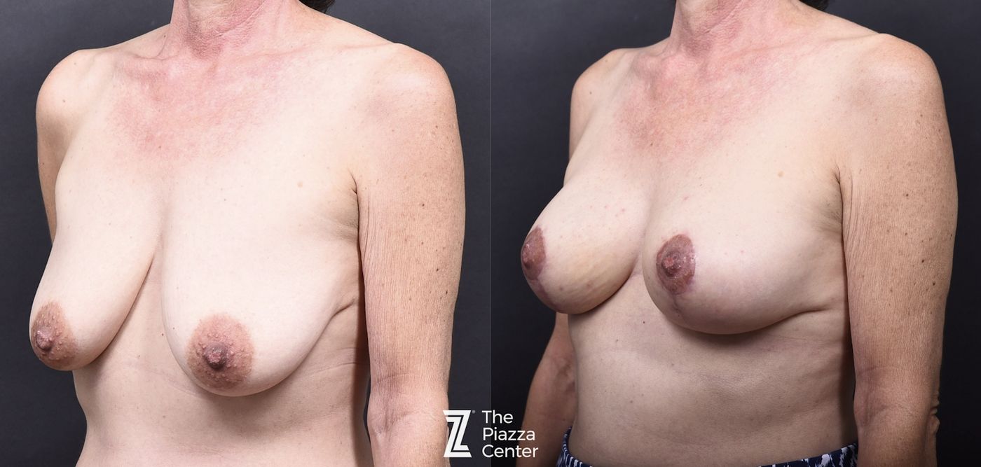 Austin Breast Augmentation With a Breast Lift - The Piazza Center