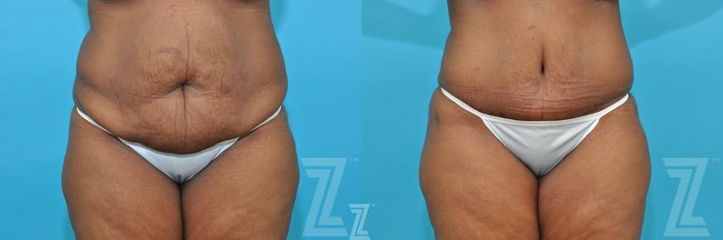 Austin Tummy Tuck Before & After Gallery - Patient 117774 - Image 1 - The Piazza Center