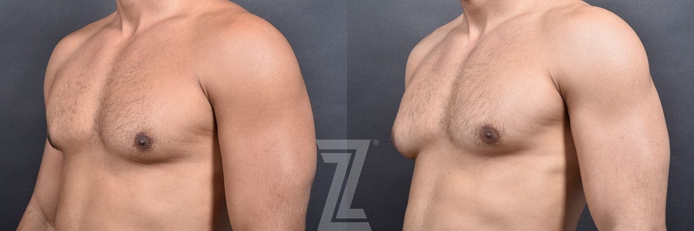 Austin Male Breast Reduction Before & After Gallery - Patient 104454 - Image 2 - The Piazza Center