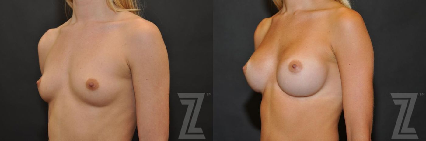 Austin oblique view of 27 year old woman before and after breast augmentation - The Piazza Center