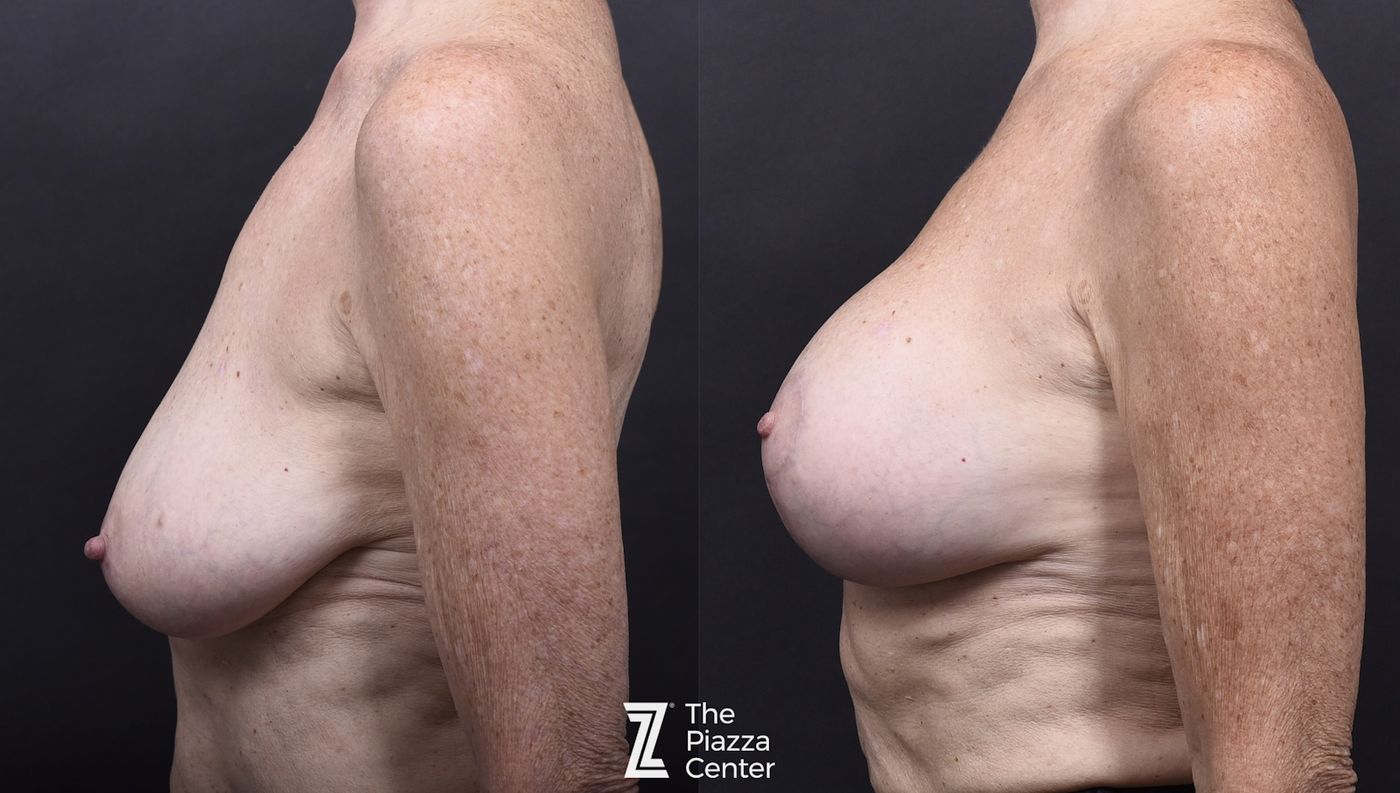 Austin Motiva Implants Before & After Gallery - Patient 406198 - Image 5 - The Piazza Center