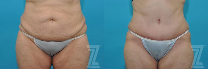Austin Tummy Tuck Before & After Gallery - Patient 132886829 - Image 1 - The Piazza Center
