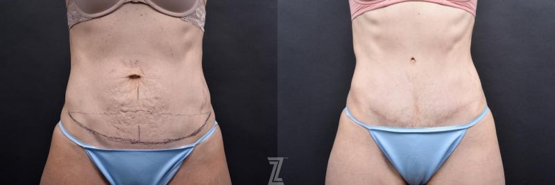 Austin Tummy Tuck Before & After Gallery - Patient 132886798 - Image 1 - The Piazza Center