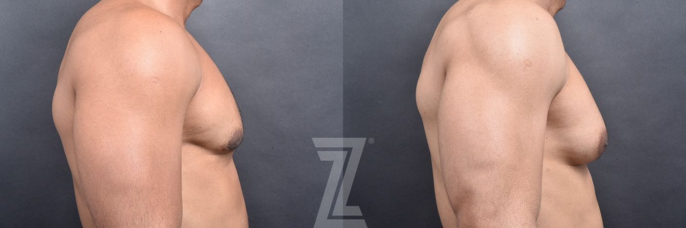 Austin Male Breast Reduction Before & After Gallery - Patient 104454 - Image 3 - The Piazza Center