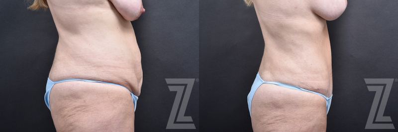 Austin Tummy Tuck Before & After Gallery - Patient 803424 - Image 1 - The Piazza Center