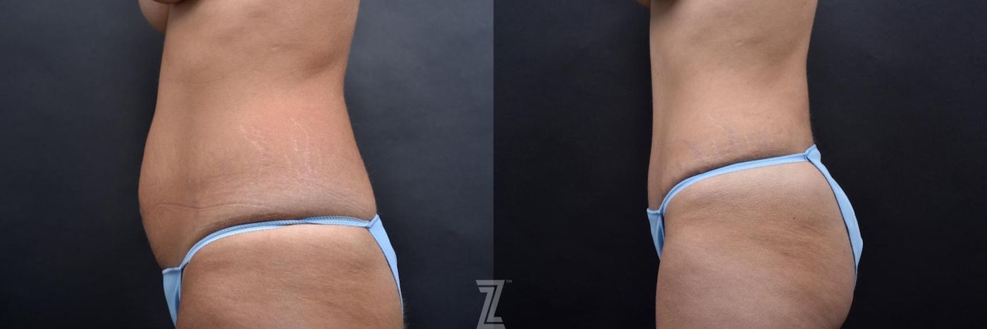 Austin Tummy Tuck Before & After Gallery - Patient 132886801 - Image 2 - The Piazza Center