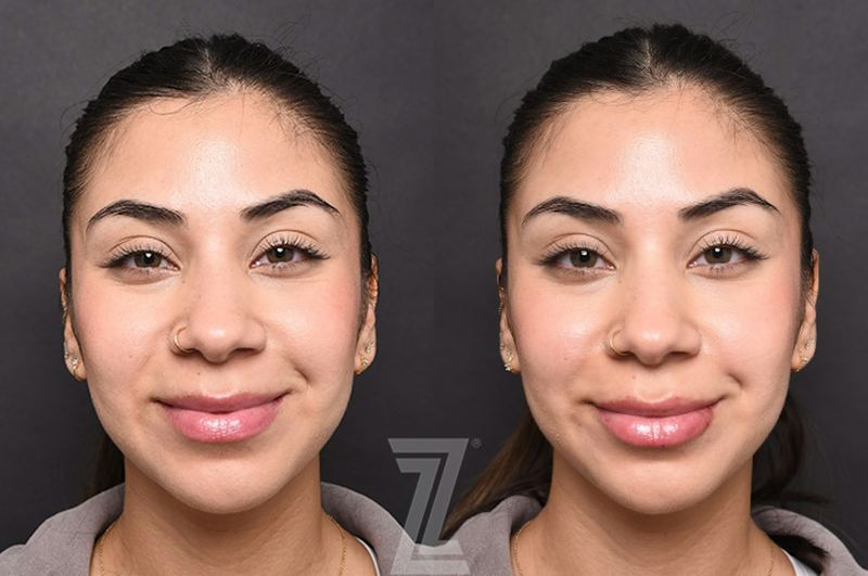 Austin Injectable Fillers Before & After Gallery - Patient 353710 - Image 1 - The Piazza Center
