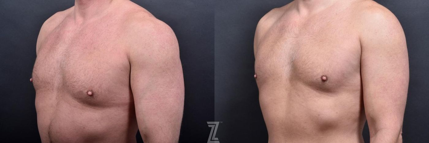 Austin Male Body Contouring Before & After Gallery - Patient 173307 - Image 4 - The Piazza Center