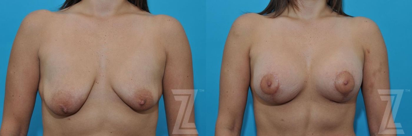 Austin Breast Augmentation With a Breast Lift Before & After Gallery - Patient 132791109 - Image 1 - The Piazza Center