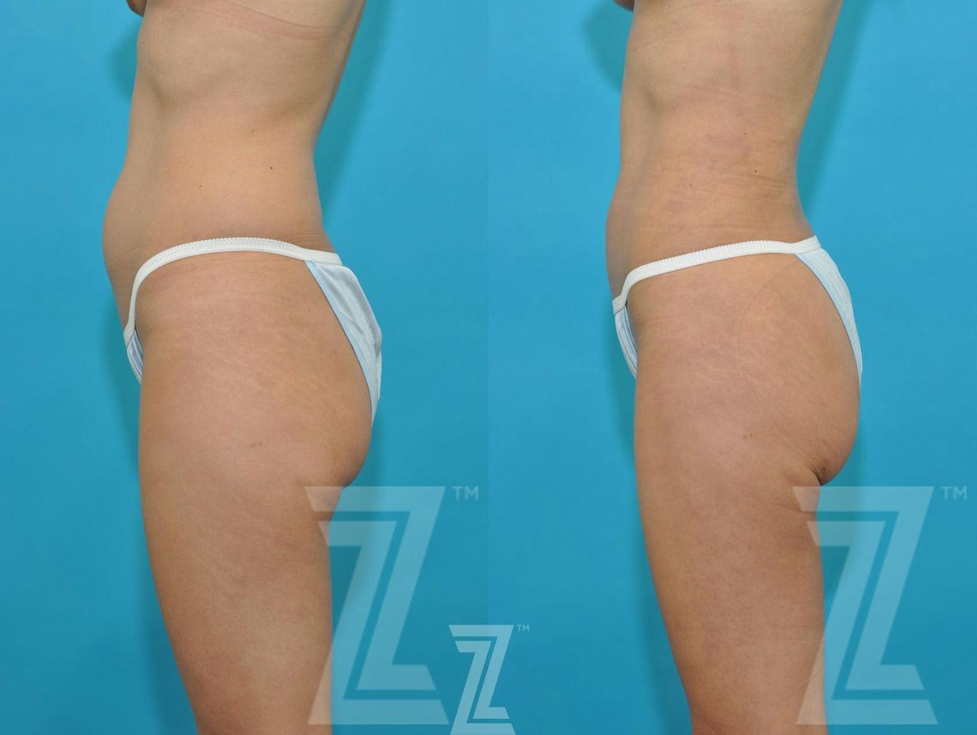 Austin Liposuction Before & After Gallery - Patient 132893822 - Image 2 - The Piazza Center
