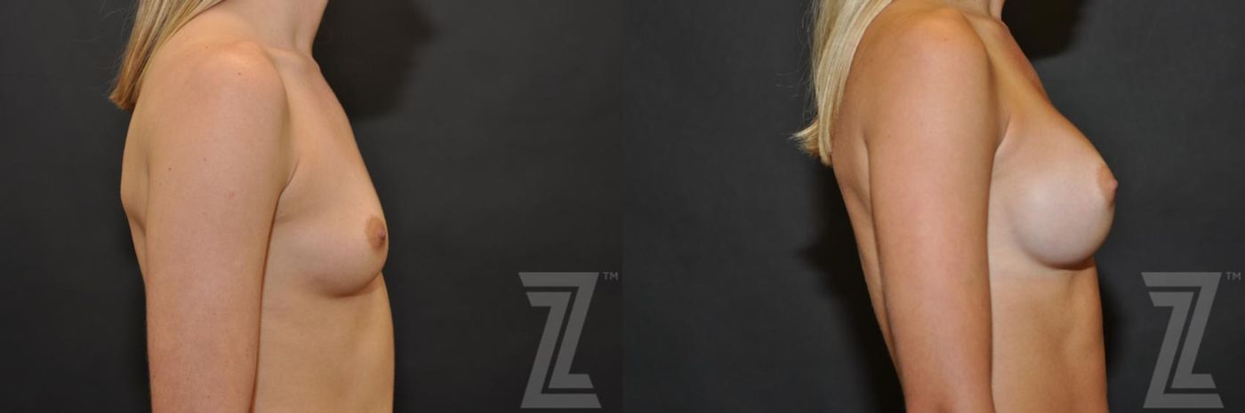 Austin lateral view of 27 year old woman before and after breast augmentation - The Piazza Center