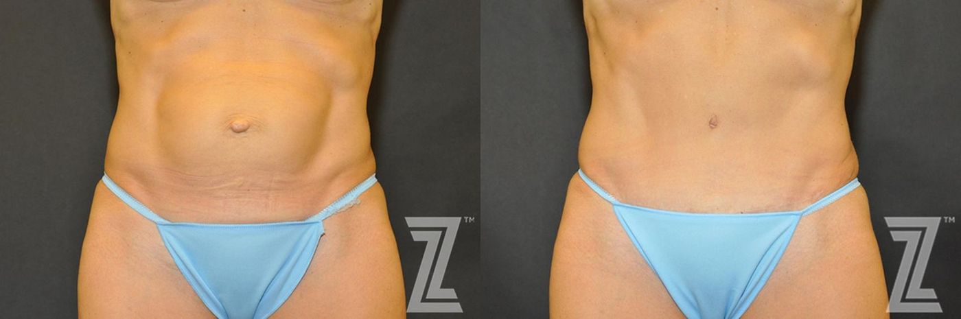 Austin Tummy Tuck Before & After Gallery - Patient 132886866 - Image 1 - The Piazza Center