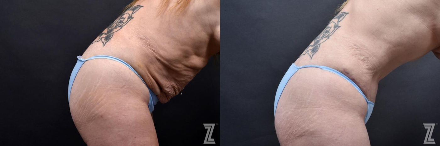 Austin Tummy Tuck Before & After Gallery - Patient 132886812 - Image 5 - The Piazza Center