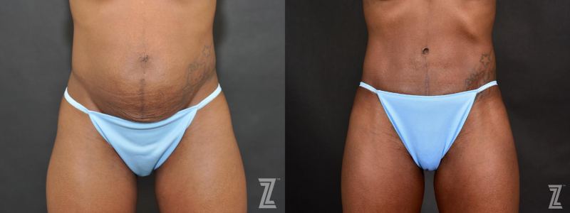 Austin Tummy Tuck Before & After Gallery - Patient 132886804 - Image 1 - The Piazza Center